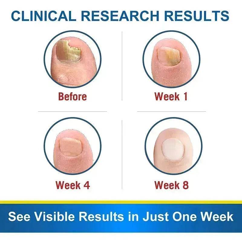 7DAYS Nail Fungus Treatment Serum Care Hand And Foot Care Removal - EX-STOCK Canada