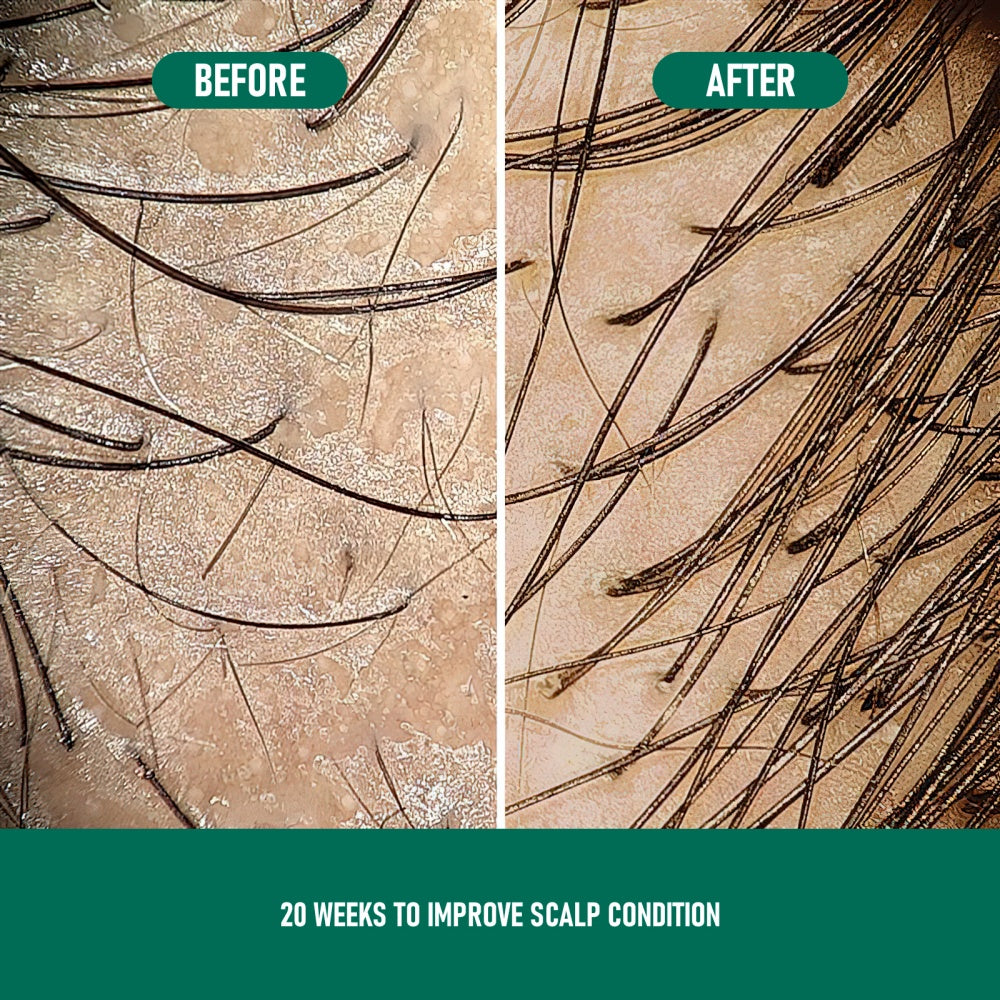 Before and after comparison of scalp with hair growth improvement over 20 weeks.