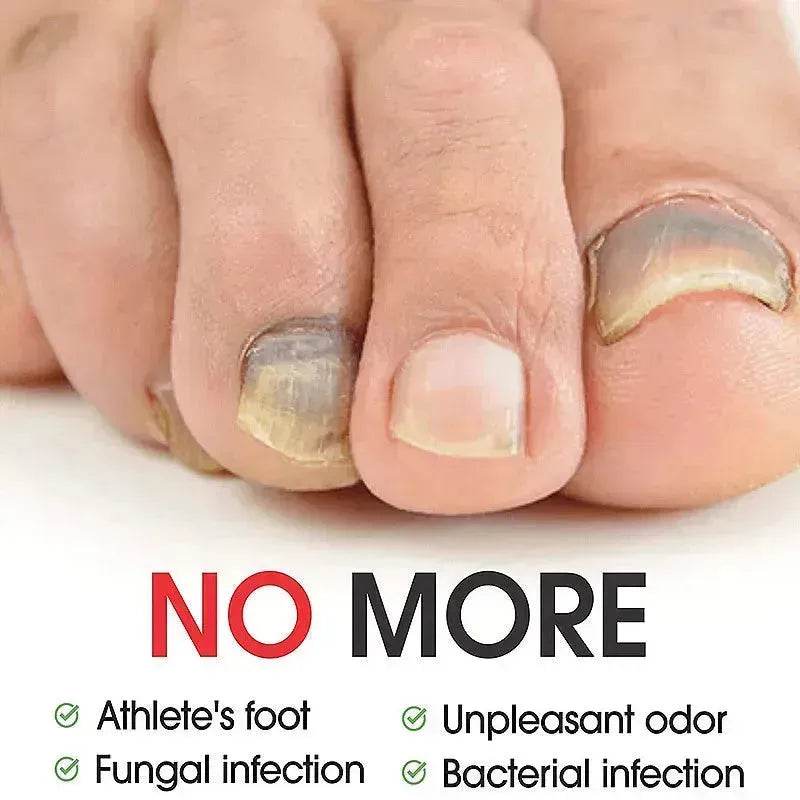 7DAYS Nail Fungus Treatment Serum Care Hand And Foot Care Removal - EX-STOCK Canada