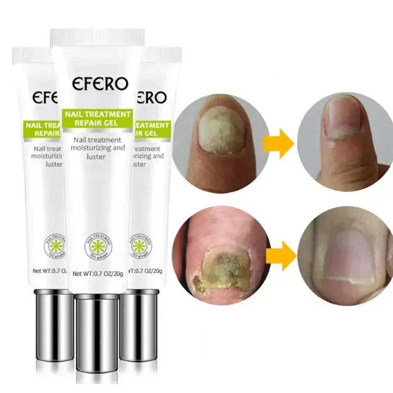Nail Treatment Serum Nail Foot Nail Fungus Removal Gel Anti Infection Onychomycosis Nail Repair Cream Feet Care - EX-STOCK Canada