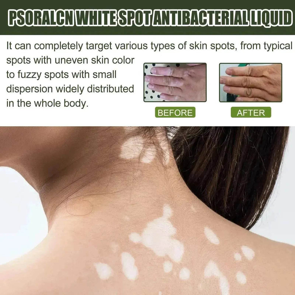 EELHOE White Spot Cleansing Serum PSORALCN White Spot Antibacterial Liquid. - EX-STOCK Canada