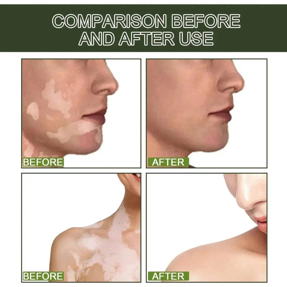 EELHOE White Spot Cleansing Serum PSORALCN White Spot Antibacterial Liquid. - EX-STOCK Canada