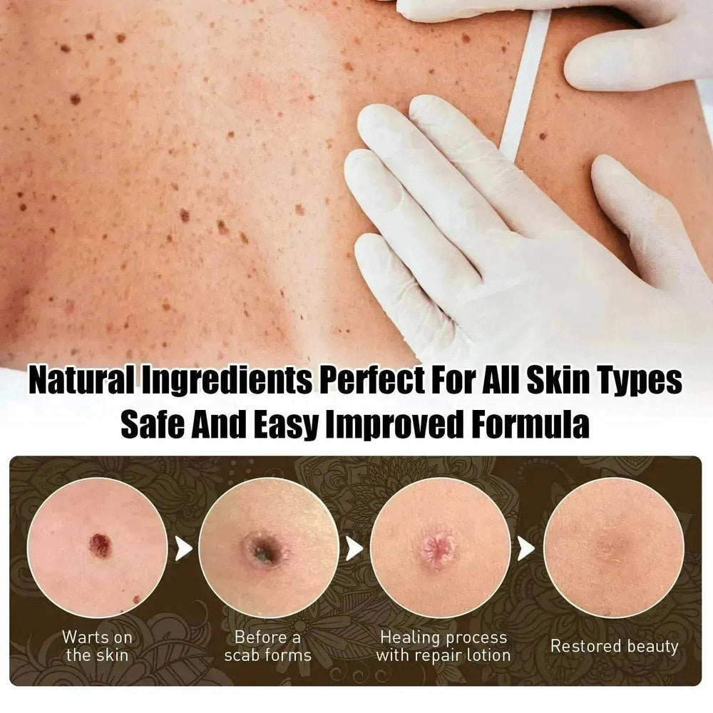 Wart Removal - Skin Cleansing Black Mole Wart Ointment Hand & Foot And Face - EX-STOCK Canada