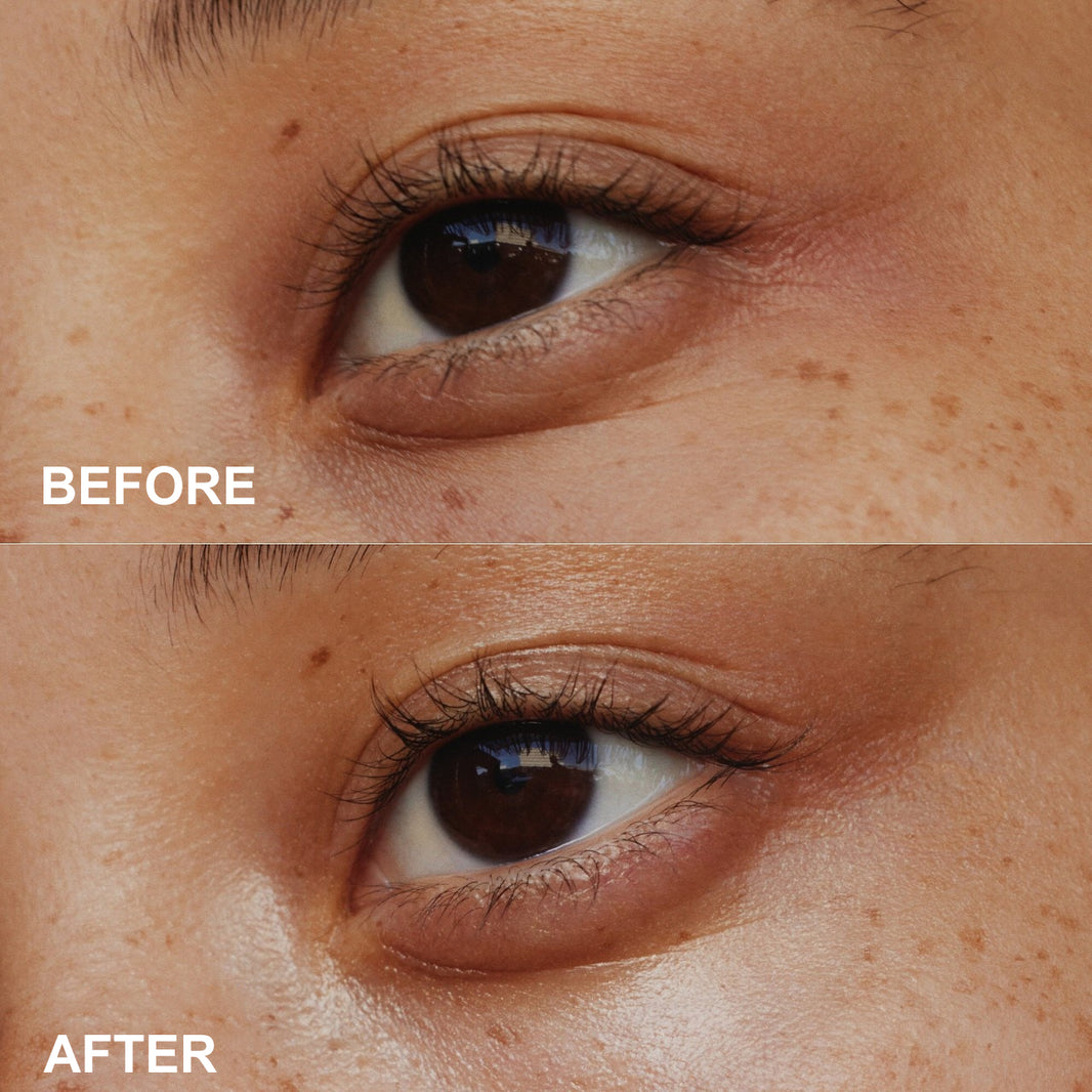 Before and after comparison of a person's eye with skin treatment effects.