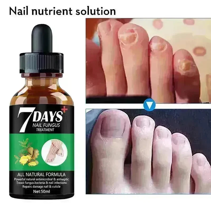 7DAYS Nail Fungus Treatment Serum Care Hand And Foot Care Removal - EX-STOCK CANADA