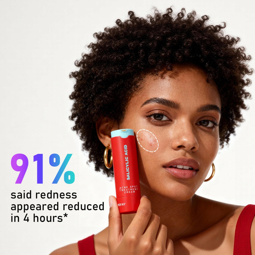 Acne Removing Lotion – Targeted Blemish Control & Skin Clarifying Treatment