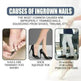 Relieving And Repairing Ingrown Nail Toe Nail Removing Meat Treatment Oil - EX-STOCK CANADA