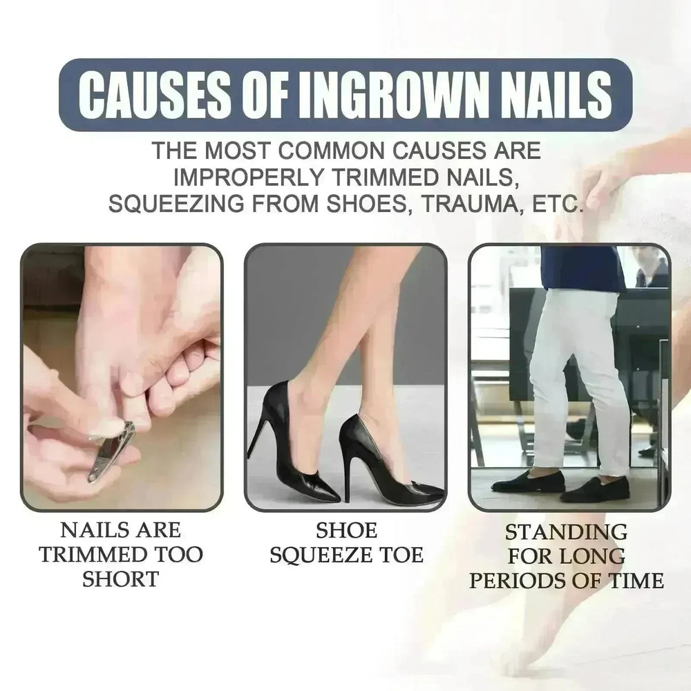 Relieving And Repairing Ingrown Nail Toe Nail Removing Meat Treatment Oil - EX-STOCK CANADA