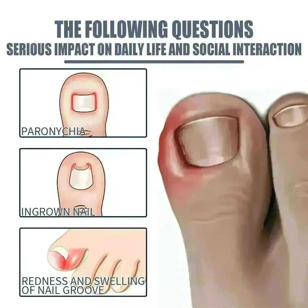 Relieving And Repairing Ingrown Nail Toe Nail Removing Meat Treatment Oil - EX-STOCK CANADA