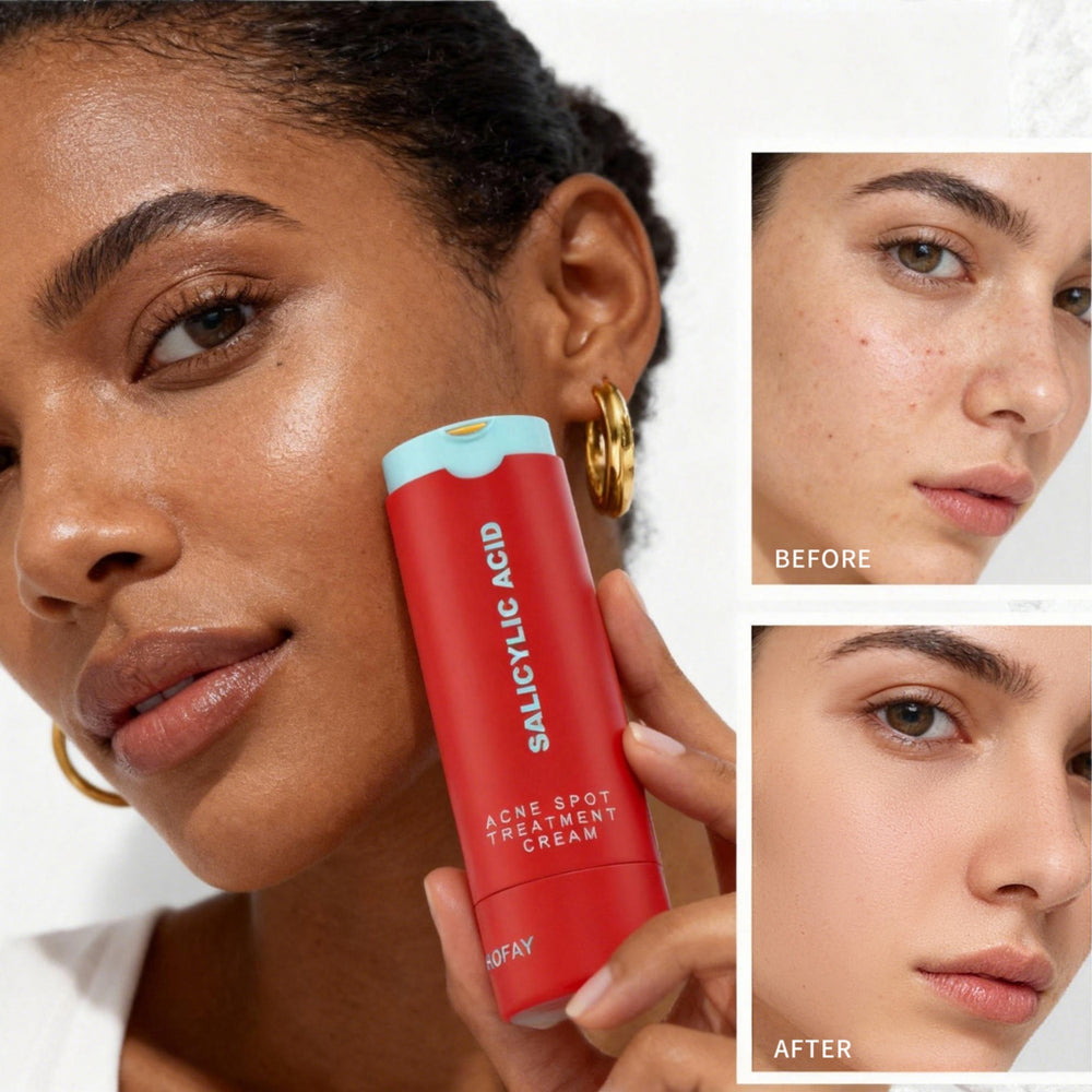 Acne Removing Lotion – Targeted Blemish Control & Skin Clarifying Treatment