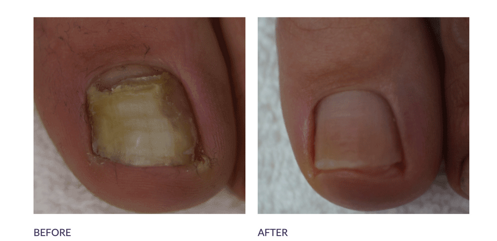 Footlogix Anti-Fungal Nail Tincture Spray EX-STOCK Canada 