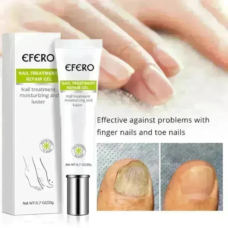 Nail Treatment Serum Nail Foot Nail Fungus Removal Gel Anti Infection Onychomycosis Nail Repair Cream Feet Care - EX-STOCK CANADA