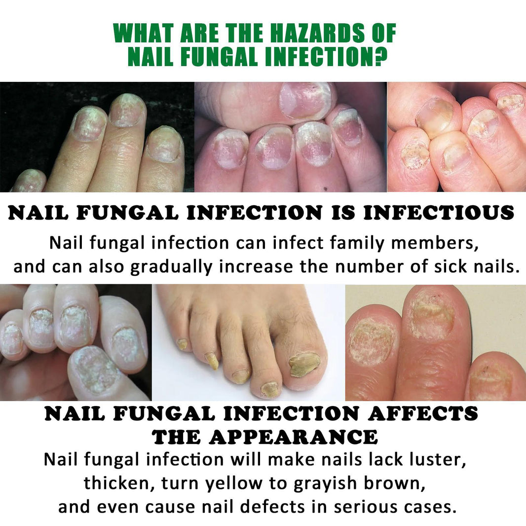 Jiasuying Ginger Nail Care Liquid, Repairs And Moisturizes Hand And Foot Nails, Makes Nails Shiny And Soft, And Improves Onychomycosis EX-STOCK